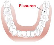 Grafik zeigt Fissuren im Unterkiefer