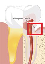 Abb. Zahn mit freiliegendem Zahnhals
